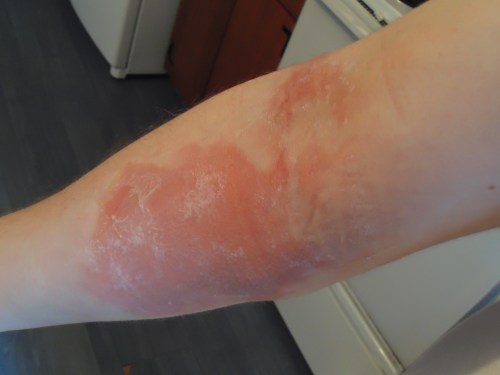 blisters now drained and skin peeling